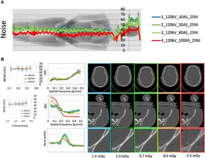 Ultra-Low-Dose Whole-Body Computed Tomography Protocol Optimization for Patients With Plasma Cell Disorders: Diagnostic Accuracy and Effective Dose Analysis From a Reference Center